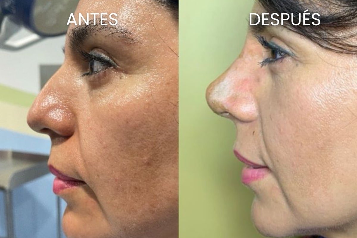 Resultados de rinoplastia en Arte y Cirugía