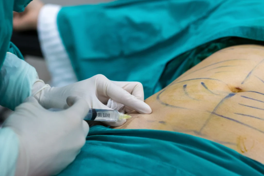 lipoescultura imagen